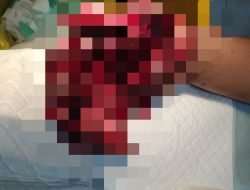 Akibat Mercon Meledak, Pemuda di Ponorogo Tiga Jari Tangannya Hancur